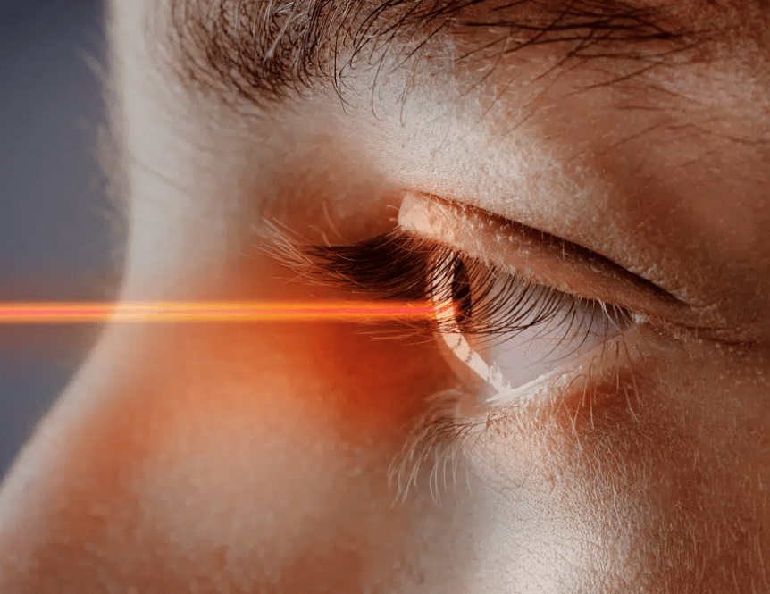 laser eye surgery